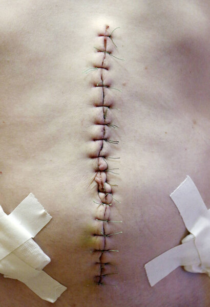 Хирургический шов после операции на брюшной полости, крупный план хирургического шва