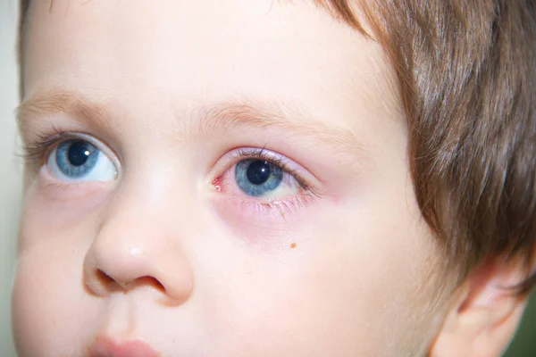 Conjuntivitis en el ojo de un niño. Enfermedades oftálmicas. Ojo rojo. Buques estallaron en el ojo . — Foto de Stock