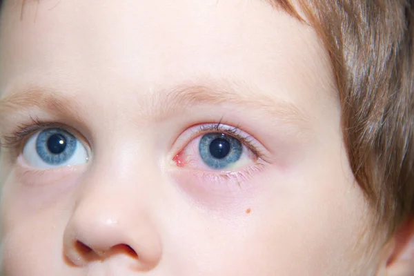 Conjuntivitis en el ojo de un niño. Enfermedades oftálmicas. Ojo rojo. Buques estallaron en el ojo . —  Fotos de Stock