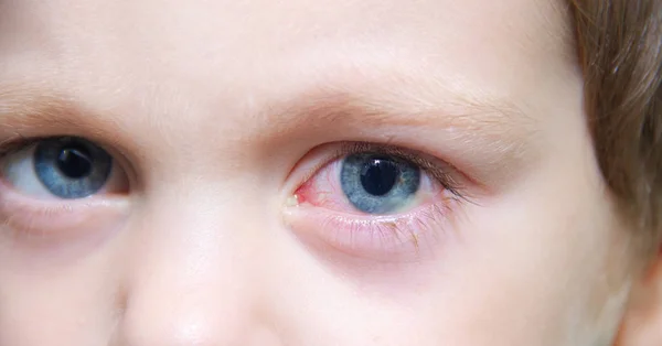 Conjuntivitis en el ojo de un niño. Enfermedades oftálmicas. Ojo rojo. Buques estallaron en el ojo . — Foto de Stock