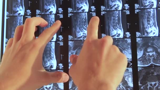 Die Hände des Arztes zeigen auf dem Röntgenbild Problemzonen des Rückens — Stockvideo