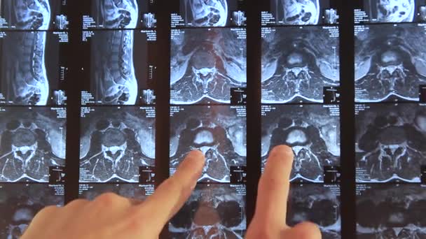 Les mains des médecins montrent des zones problématiques du dos sur la radiographie 