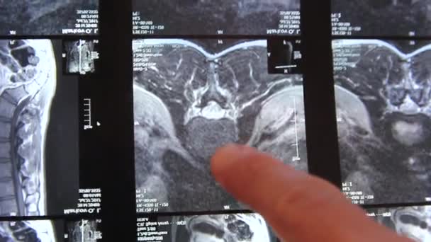 Les mains des médecins montrent des zones problématiques du dos sur la radiographie — Video