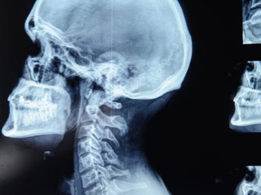 Servikal omurganın röntgen filmi.