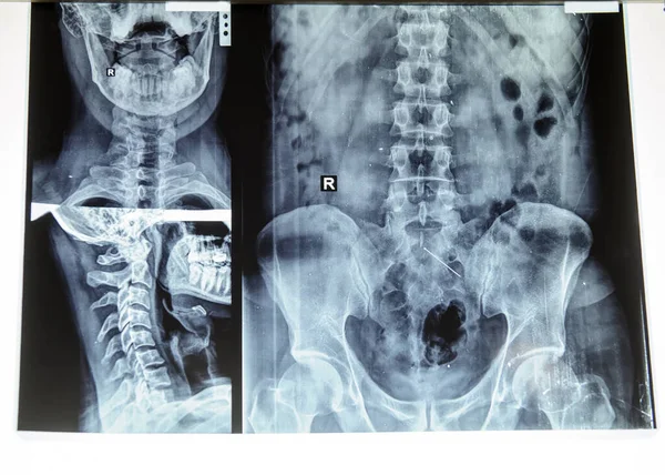 Complex x-ray with cervical and lombar spine and coxofemural joint