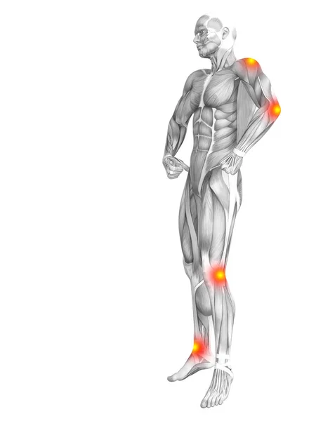 Konzeptionelle Menschliche Muskelanatomie Mit Rot Gelben Hotspot Entzündungen Oder Gelenkschmerzen — Stockfoto