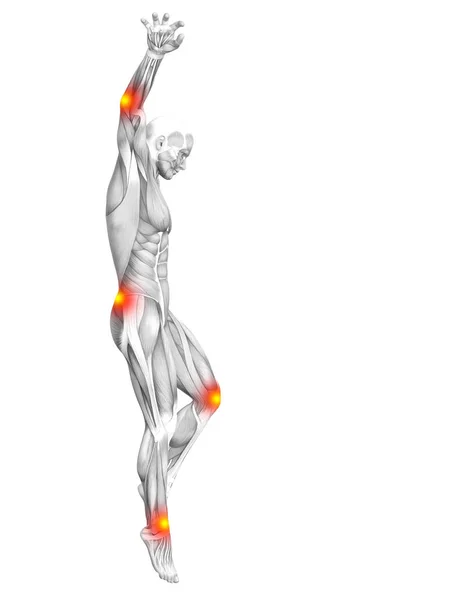 Conceptuele Menselijke Spier Anatomie Met Rode Gele Hotspot Ontsteking Articulaire — Stockfoto