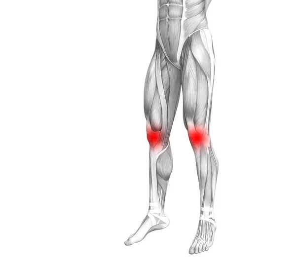 Anatomie Van Het Conceptuele Knieën Met Rode Hotspots Ontsteking — Stockfoto