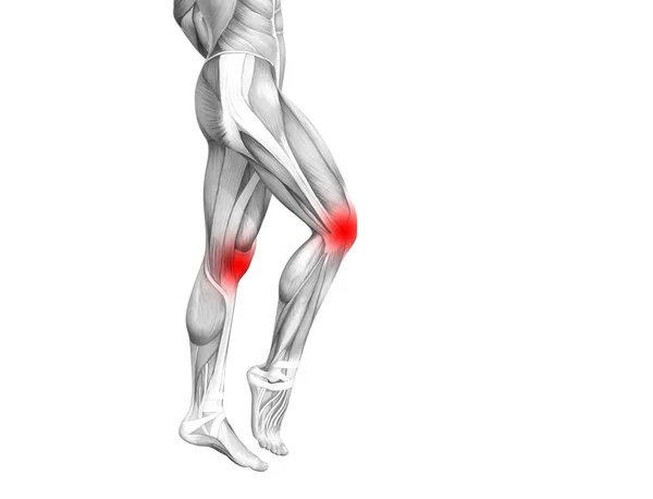 Konzeptionelle Anatomie Des Kniegelenks Mit Entzündungen Des Roten Hotspots Oder — Stockfoto