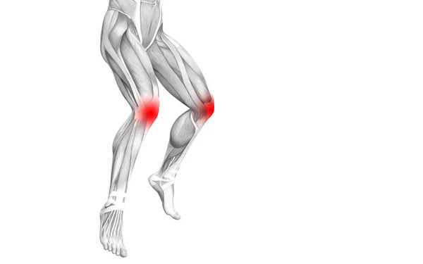 Концептуальная Анатомия Колена Человека Воспалением Красной Горячей Точки Суставной Болью — стоковое фото