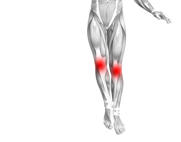 赤のホット スポットの炎症や足医療療法やスポーツ筋概念の関節の関節痛と概念的な膝人体解剖学 イラストの人関節炎や骨骨粗鬆症病 — ストック写真