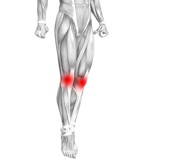 Anatomía Humana Rodillas Conceptuales Con Puntos Calientes Rojos Inflamación Dolor —  Fotos de Stock