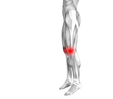 Kırmızı sıcak nokta iltihap veya bacak sağlık tedavi veya spor kas kavramı için Parçalanmõ * eklem ağrısı ile kavramsal diz insan anatomisi. 3D çizim adam artrit veya kemik osteoporoz hastalığı