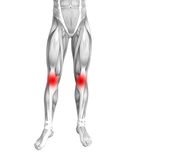 赤のホット スポットの炎症や足医療療法やスポーツ筋概念の関節の関節痛と概念的な膝人体解剖学 イラストの人関節炎や骨骨粗鬆症病 — ストック写真