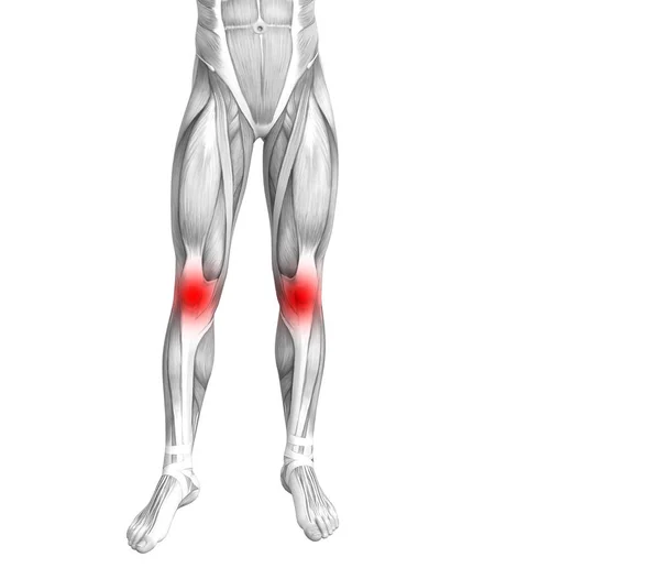 Konzeptionelle Anatomie Des Kniegelenks Mit Entzündungen Des Roten Hotspots Oder — Stockfoto