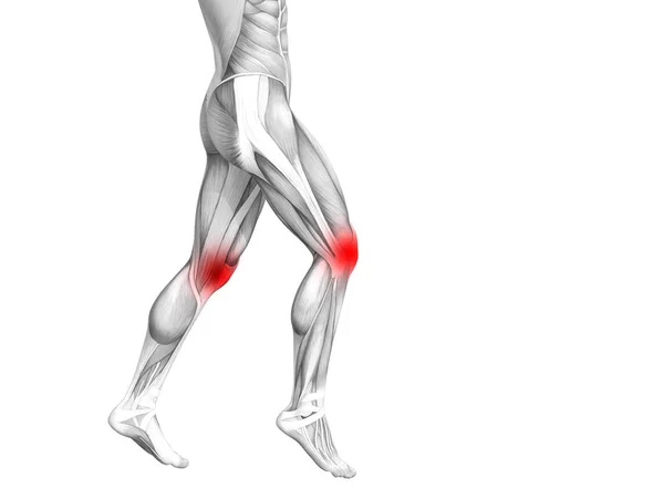 Konzeptionelle Anatomie Des Kniegelenks Mit Entzündungen Des Roten Hotspots Oder — Stockfoto