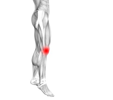 Kırmızı sıcak nokta iltihap veya bacak sağlık tedavi veya spor kas kavramı için Parçalanmõ * eklem ağrısı ile kavramsal diz insan anatomisi. 3D çizim adam artrit veya kemik osteoporoz hastalığı