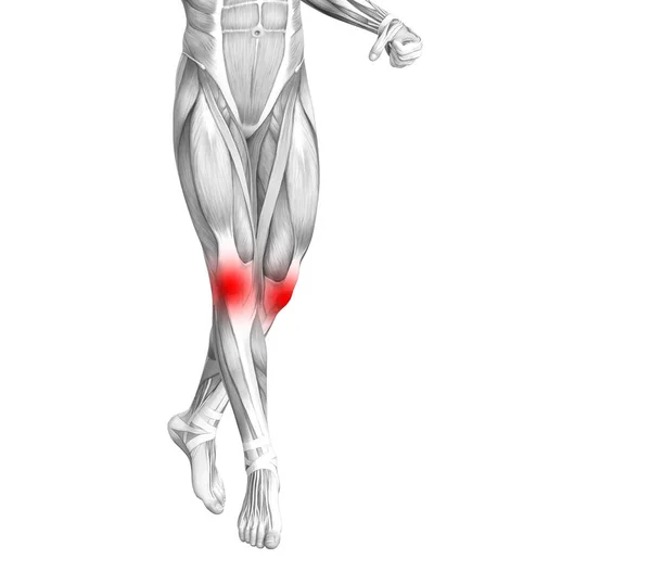 Anatomia humana do joelho conceitual com inflamação do ponto quente vermelho ou dor nas articulações articulares para a terapia de saúde das pernas ou conceitos de músculos esportivos. ilustração 3D homem artrite ou doença da osteoporose óssea — Fotografia de Stock