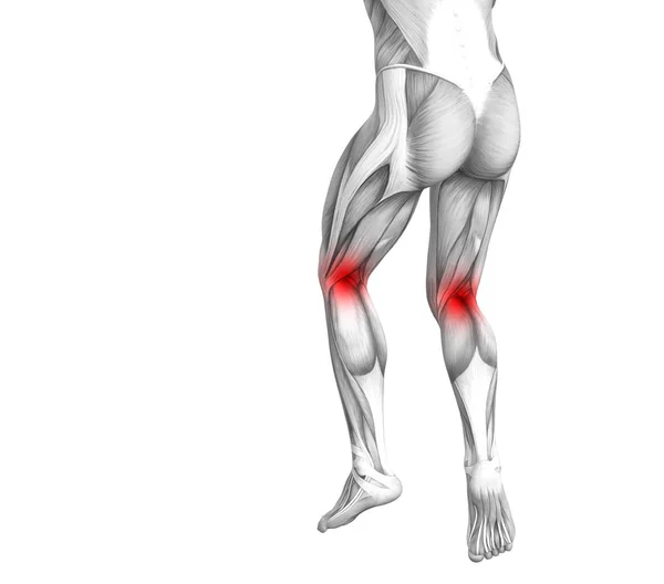 Konzeptionelle Anatomie des Kniegelenks mit Entzündungen des roten Hotspots oder Gelenkschmerzen für die Beintherapie oder Sportmuskelkonzepte. 3D Illustration Mann Arthritis oder Knochen-Osteoporose-Erkrankung — Stockfoto