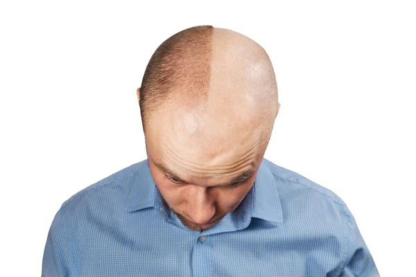 Retrato Hombre antes y después de la pérdida del cabello, trasplante sobre fondo blanco aislado. Personalidad dividida . — Foto de Stock