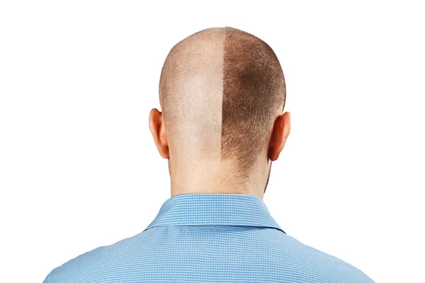 Retrato Hombre antes y después de la pérdida del cabello, trasplante sobre fondo blanco aislado. Personalidad dividida, Vista trasera —  Fotos de Stock