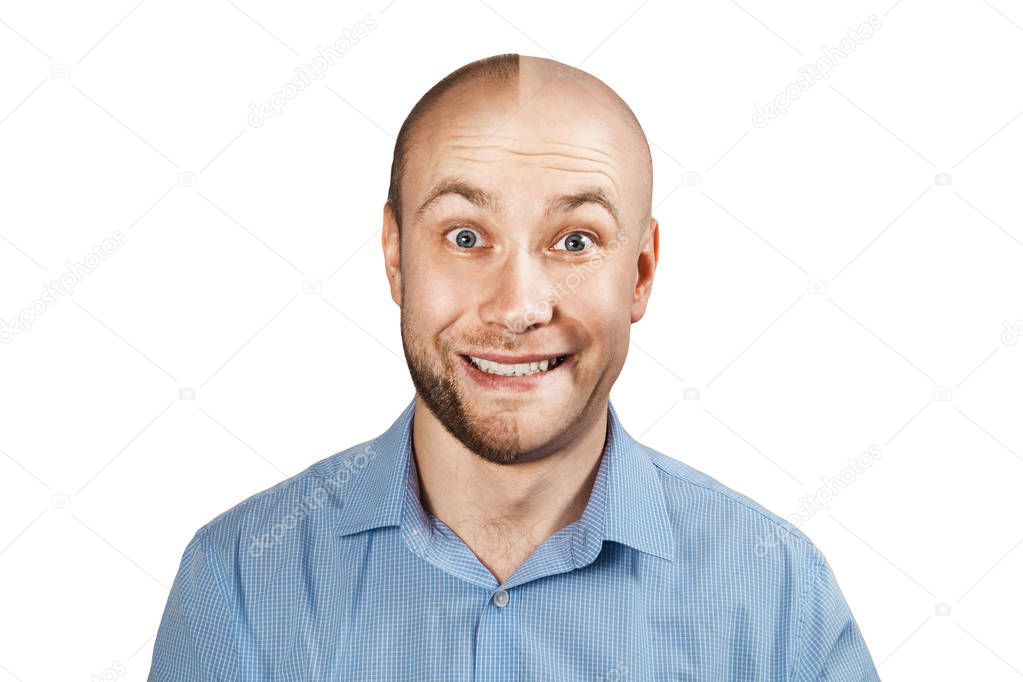 Portrait Man before and after hair loss, transplant on isolated white background. Split personality.