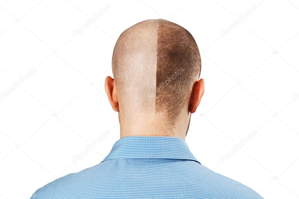 Portrait Man before and after hair loss, transplant on isolated white background. Split personality, Back view
