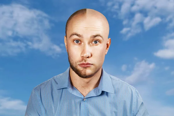 Portrét muž před a po ztrátě vlasů se transplantovat na modrém nebeském pozadí. Rozdělit osobnost. — Stock fotografie
