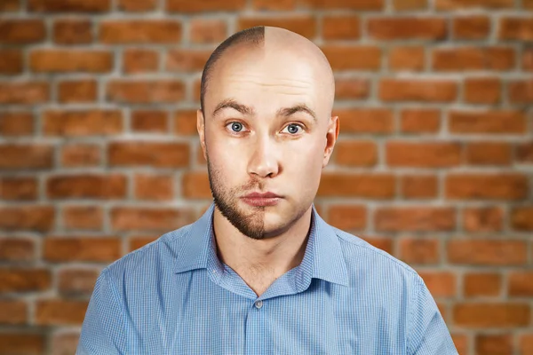 Retrato Hombre antes y después de la pérdida de cabello, trasplante en el fondo de la pared de ladrillo. Personalidad dividida . — Foto de Stock