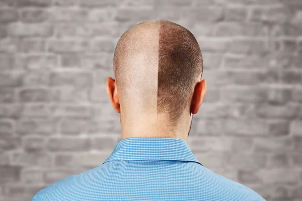 Ritratto Uomo prima e dopo la caduta dei capelli, trapianto su fondo bianco muro di mattoni. Dividere la personalità, Vista posteriore — Foto Stock