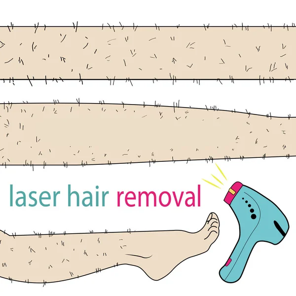 Esboço desenhado em vetor: mulher remove o cabelo das pernas peludas com depilação a laser em um fundo isolado — Vetor de Stock