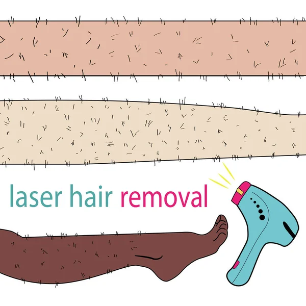 Esboço desenhado em vetor: mulher remove o cabelo das pernas peludas com depilação a laser em um fundo isolado — Vetor de Stock