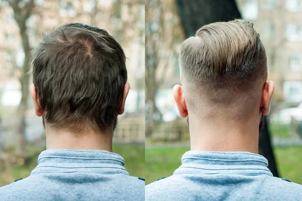 Calvo Antes Después Corte Pelo Concepto Para Una Peluquería Hombre —  Fotos de Stock