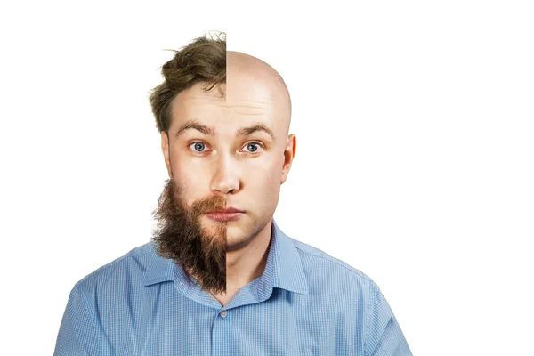 胡子和头发都刮了一半的男人 在移植和脱发之前和之后的家伙 因白人背景而被隔离 — 图库照片