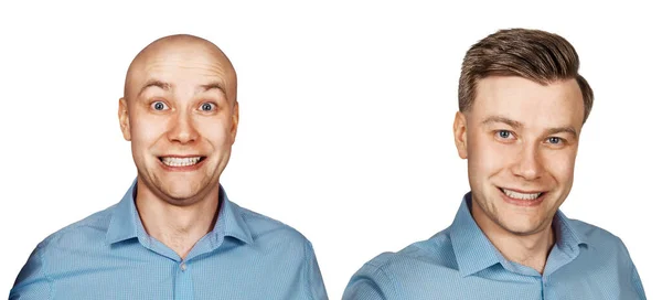 Man Före Och Efter Transplantation Hår Och Alopeci Isolerad Vit — Stockfoto