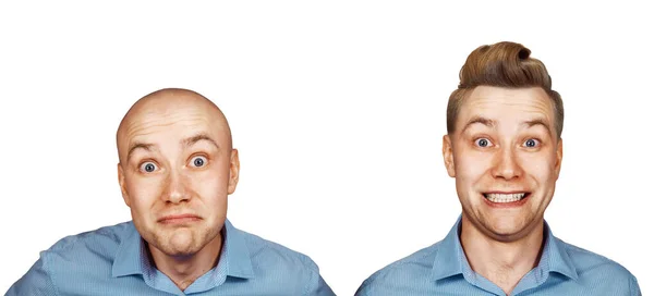 Nakil Öncesi Sonrası Saç Saç Dökülmesi Beyaz Arkaplanda Izole — Stok fotoğraf
