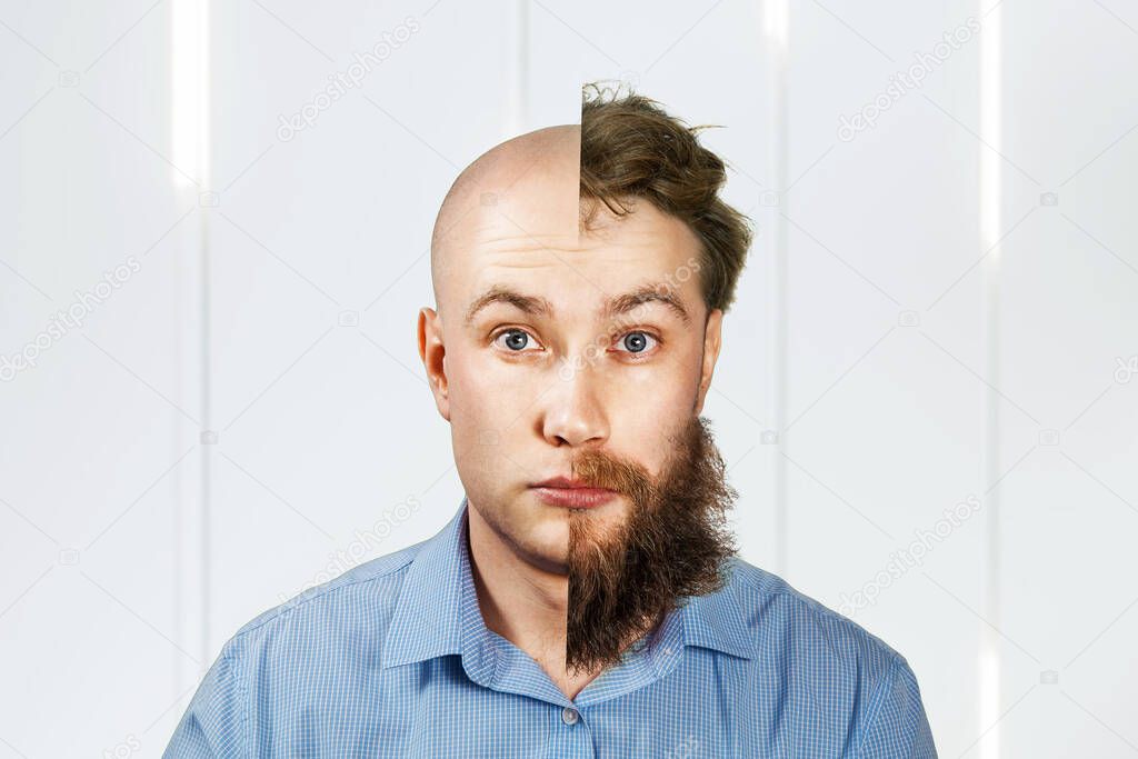 Man with half shaved beard and hair head. Guy before and after transplant and alopecia. Isolated on white background.