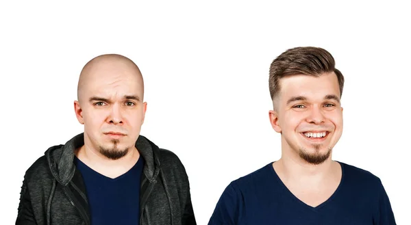 Nakil öncesi ve sonrası saç ve saç dökülmesi. Beyaz arkaplanda izole.