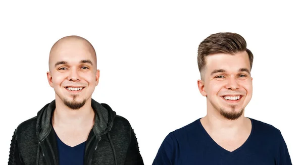 Homem Antes Depois Transplante Cabelo Alopecia Isolado Sobre Fundo Branco — Fotografia de Stock