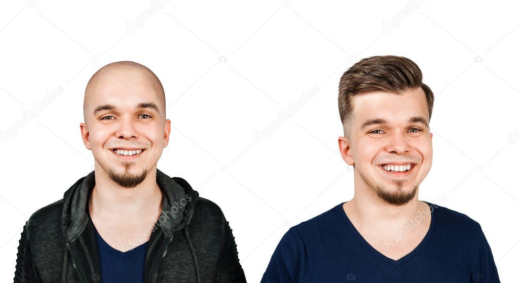 Man before and after transplant hair and alopecia. Isolated on white background.