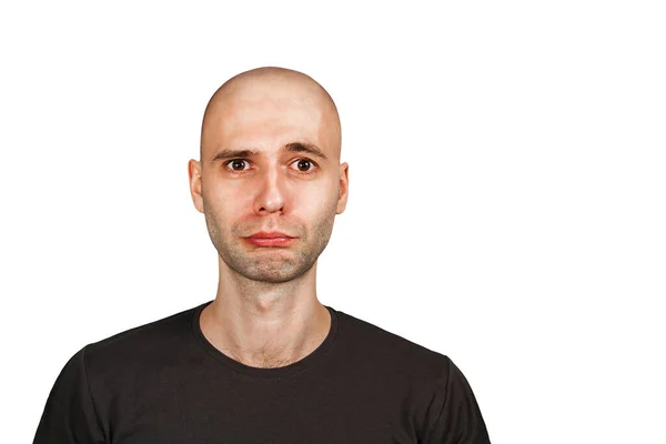 Confused Young Bald Man Alopecia Guy Skin Head Hair Loss — Stock Photo, Image