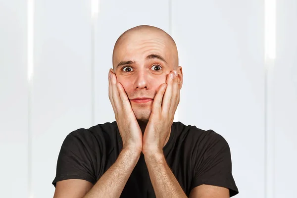 Jovem Careca Confuso Com Alopecia Cara Cabeça Pele Com Perda — Fotografia de Stock