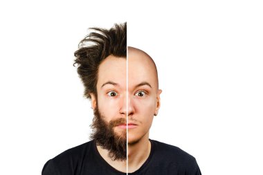 Man with half shaved hair head. Guy before and after transplant and alopecia. Isolated on white clipart