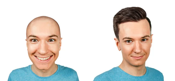 Plešatý Muž Před Transplantaci Vlasů Alopecie Izolováno Bílém Pozadí — Stock fotografie