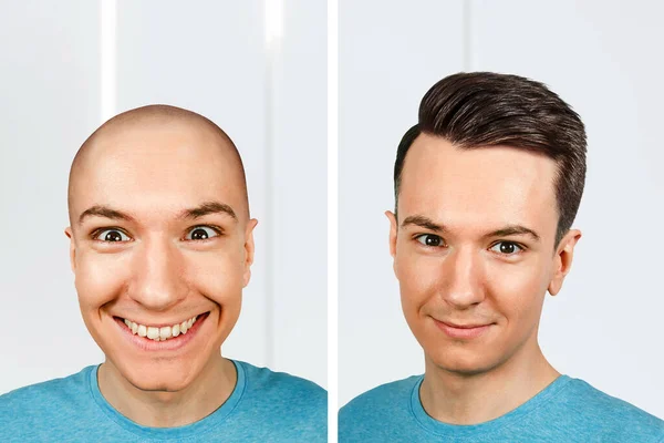 Kopasz Fickó Átültetése Előtt Után Haj Alopecia — Stock Fotó