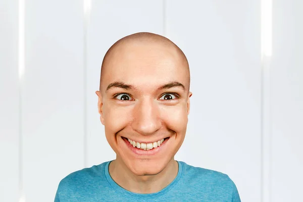 Gelukkige Jonge Kale Man Met Alopecia Man Huid Hoofd Met — Stockfoto