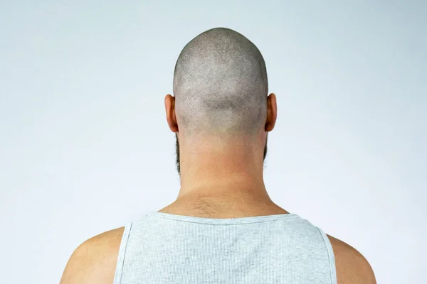 portrait of a head bald guy with alopecia, back view.