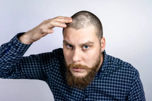 Man Met Alopecia Het Hoofd Raakt Haar Aan Kijkt Spiegel — Stockfoto