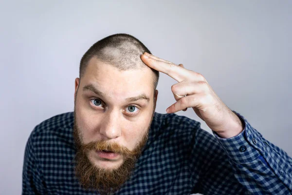 Man Met Alopecia Het Hoofd Raakt Haar Aan Kijkt Spiegel — Stockfoto