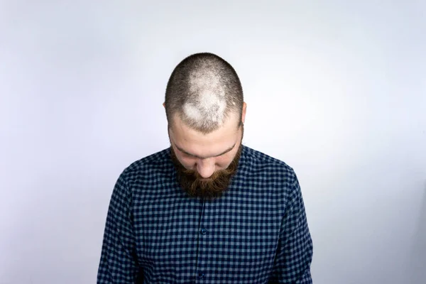 Hombre Con Alopecia Cabeza Calvicie Mancha Problema Caída Del Cabello —  Fotos de Stock